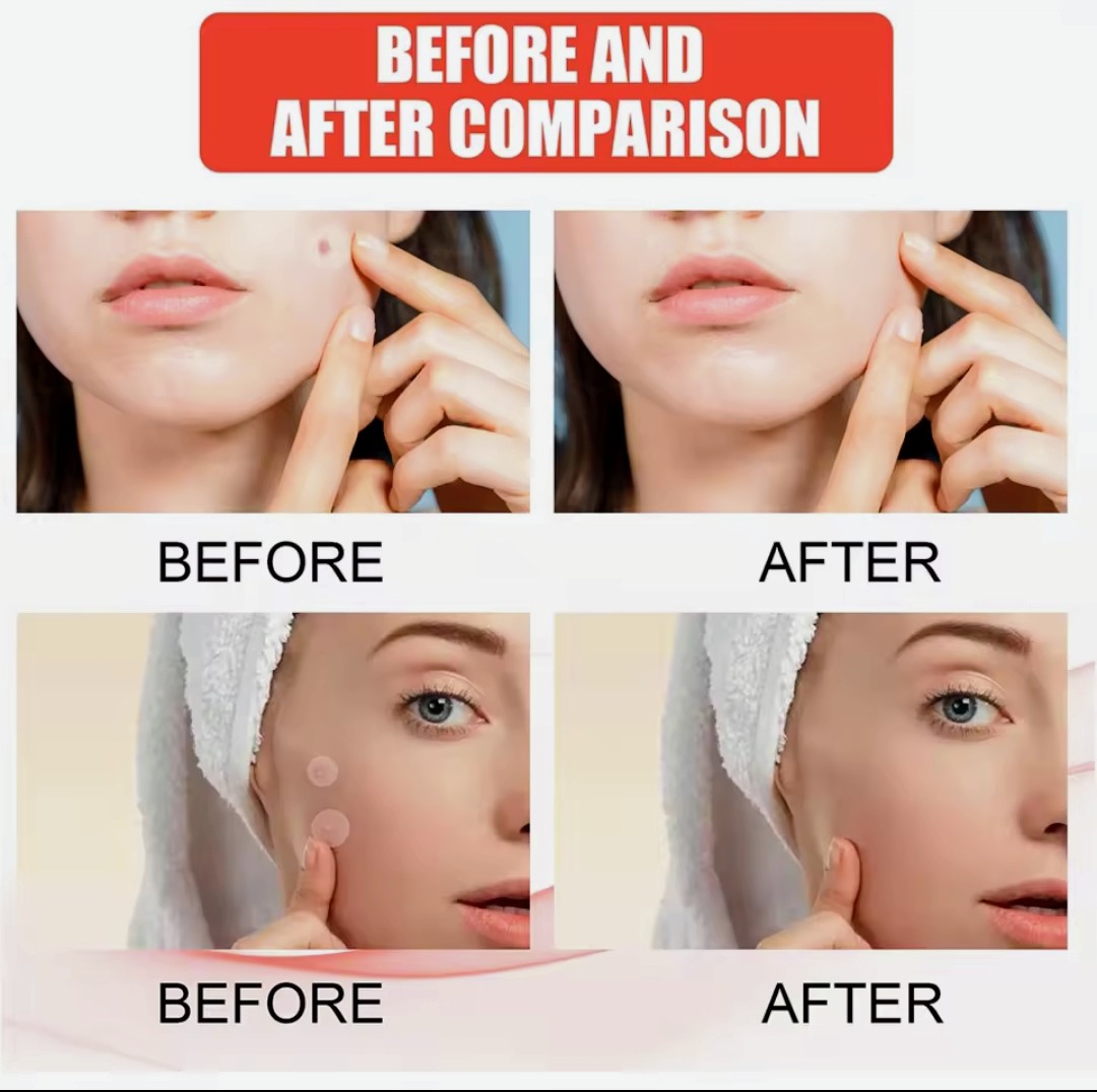 144-Count Hydrocolloid Acne Patches - Invisible Pimple & Blemish Spot Treatment, Fast Healing Absorbency Patches for Face